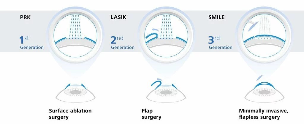 Lazerle göz çizdirme yöntemleri: PRK yüzey ablasyonu, LASIK flepli, SMILE flepsiz